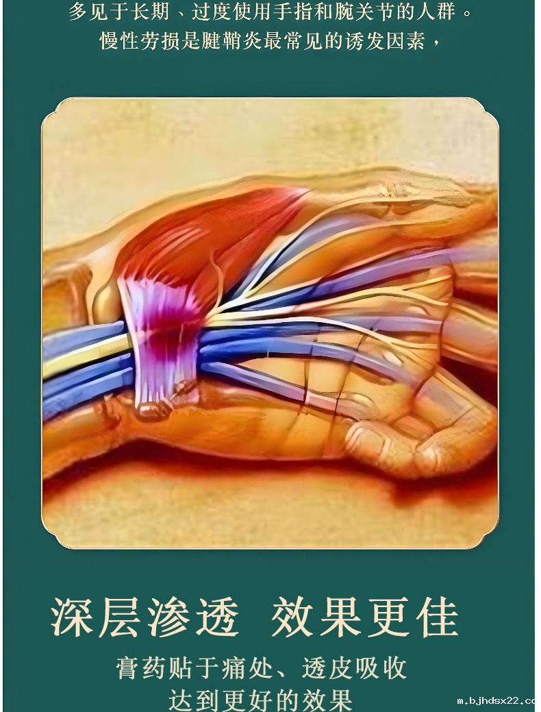 腱鞘炎膏药贴深层渗透效果更佳